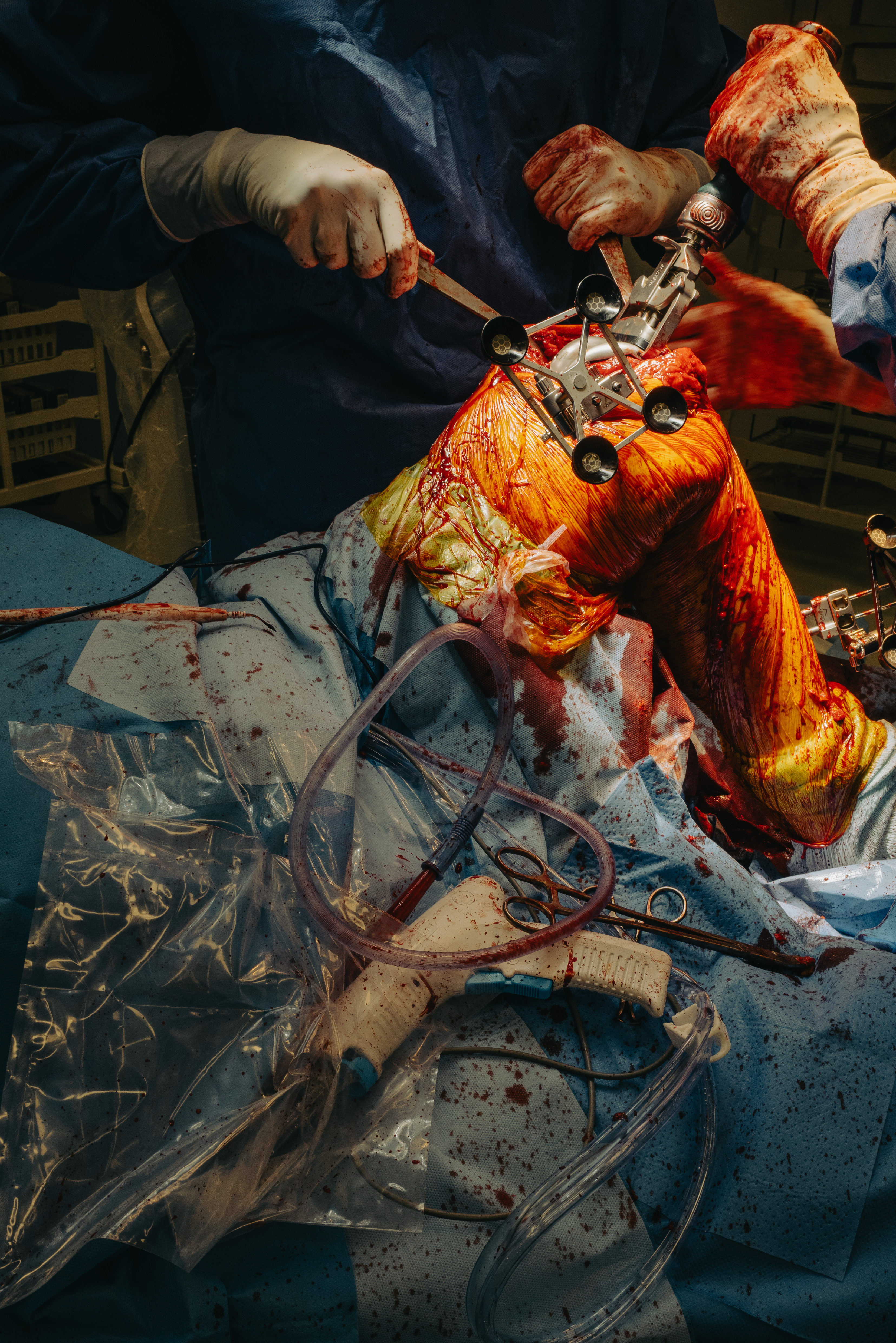 3 months in a surgery room.